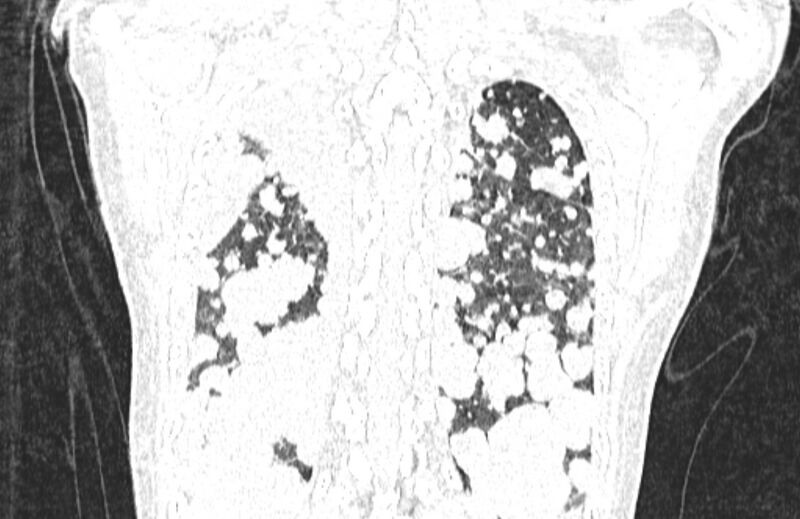 File:Cannonball metastases from breast cancer (Radiopaedia 91024-108569 Coronal lung window 123).jpg