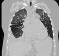 Cardiogenic pulmonary edema (Radiopaedia 29213-29609 Coronal lung window 28).jpg