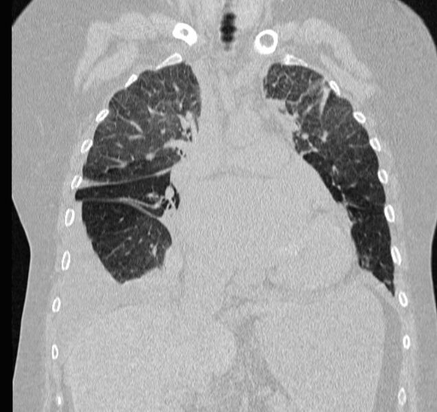 File:Cardiogenic pulmonary edema (Radiopaedia 29213-29609 Coronal lung window 28).jpg