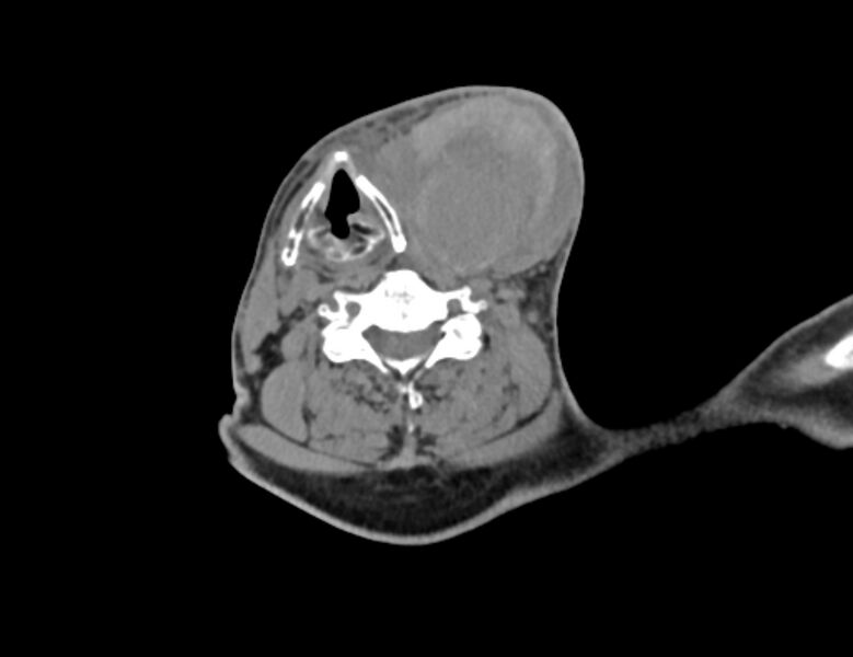 File:Carotid artery pseudoaneurysm (Radiopaedia 84030-99259 Axial non-contrast 32).jpg