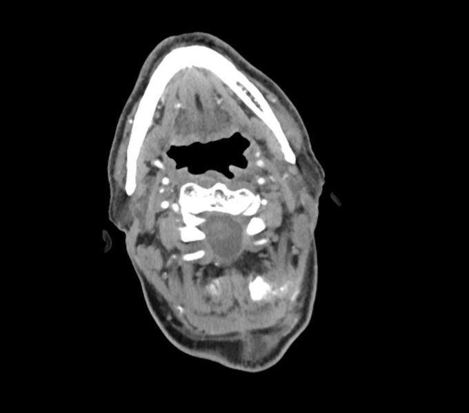 File:Carotid artery pseudoaneurysm (Radiopaedia 84030-99259 C 27).jpg