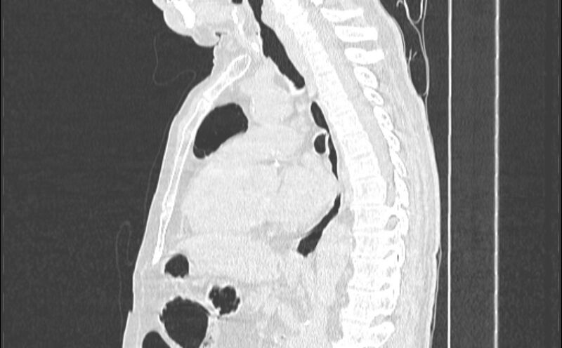 File:Cavitating bronchogenic carcinoma (Radiopaedia 44489-48162 Sagittal lung window 33).jpg