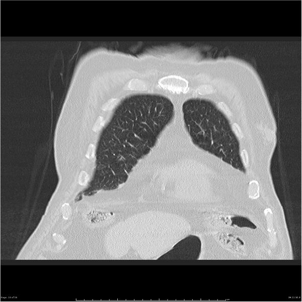 File:Cavitating left lower lobe lesion - squamous cell lung cancer (Radiopaedia 27749-28176 Coronal lung window 10).jpg