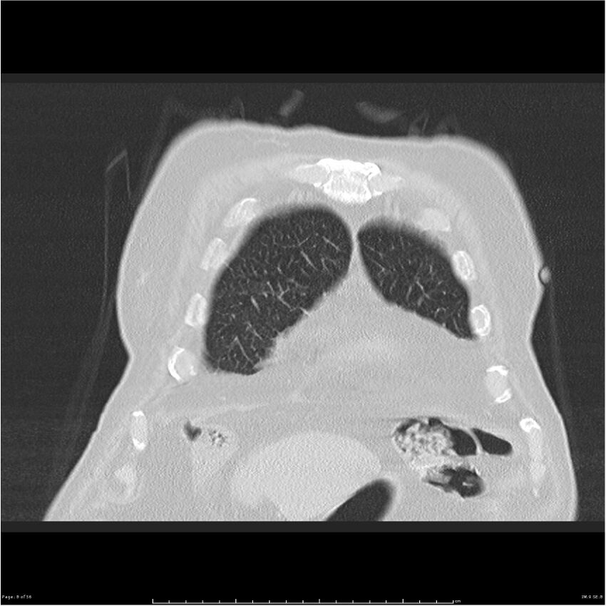 Cavitating left lower lobe lesion - squamous cell lung cancer (Radiopaedia 27749-28176 Coronal lung window 8).jpg
