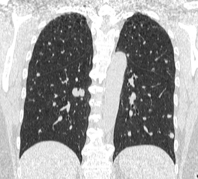 File:Cavitating pulmonary metastases (Radiopaedia 17796-17555 Coronal lung window 19).jpg