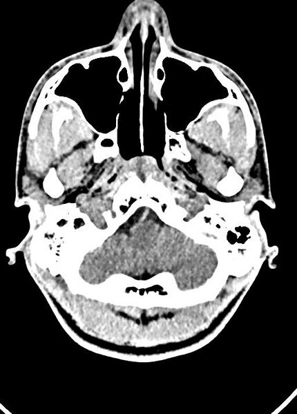 File:Cavum septum pellucidum and cavum vergae (Radiopaedia 77797-90060 Axial Brain Window 14).jpg