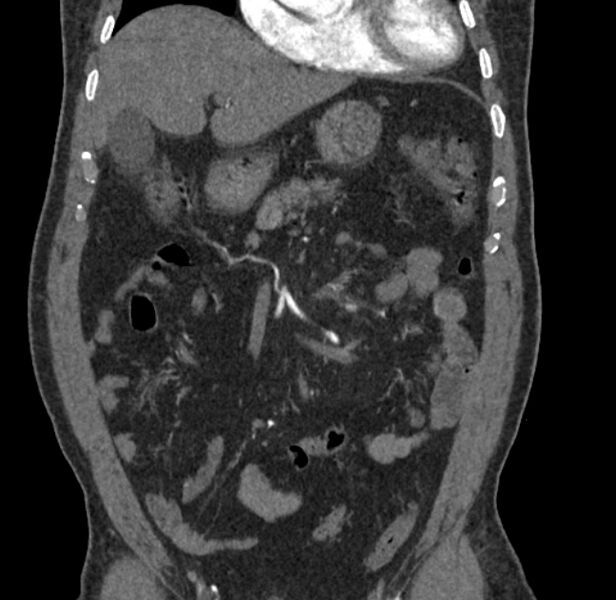 File:Celiac artery dissection (Radiopaedia 52194-58080 C 5).jpg
