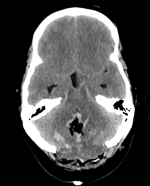 File:Cerebellar ependymoma complicated by post-operative subdural hematoma (Radiopaedia 83322-97737 Axial non-contrast 21).png