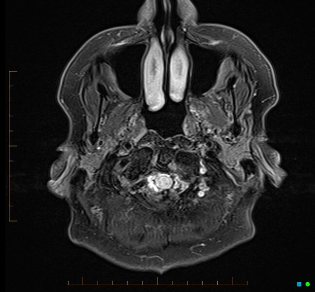 File:Cerebellar gangliocytoma (Radiopaedia 65377-74422 Axial FLAIR 1).jpg