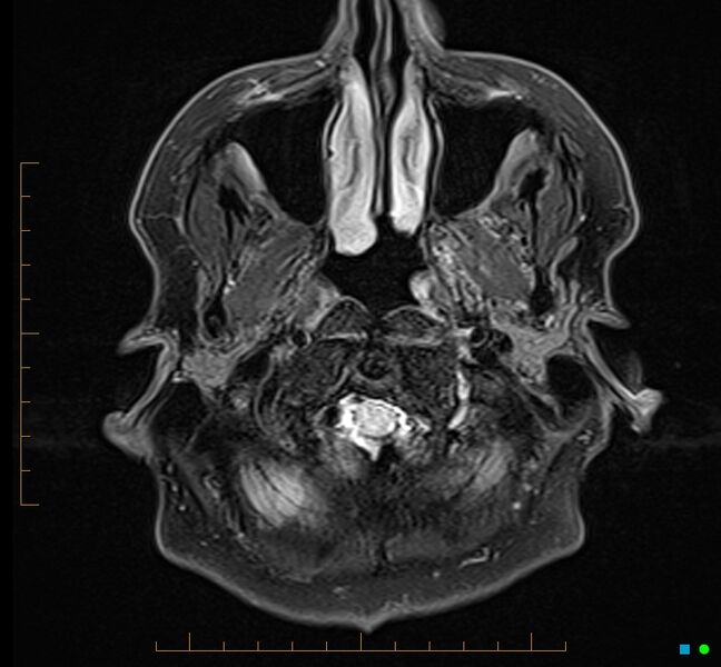 File:Cerebellar gangliocytoma (Radiopaedia 65377-74422 Axial FLAIR 2).jpg