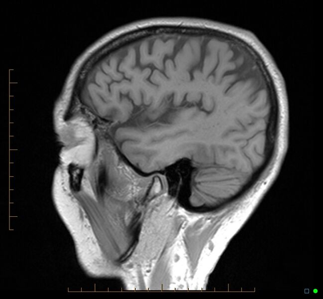 File:Cerebellar gangliocytoma (Radiopaedia 65377-74422 Sagittal T1 8).jpg