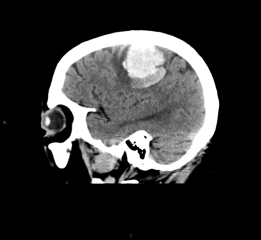 Cerebral amyloid angiopathy-associated lobar intracerebral hemorrhage (Radiopaedia 58376-65511 C 40).jpg
