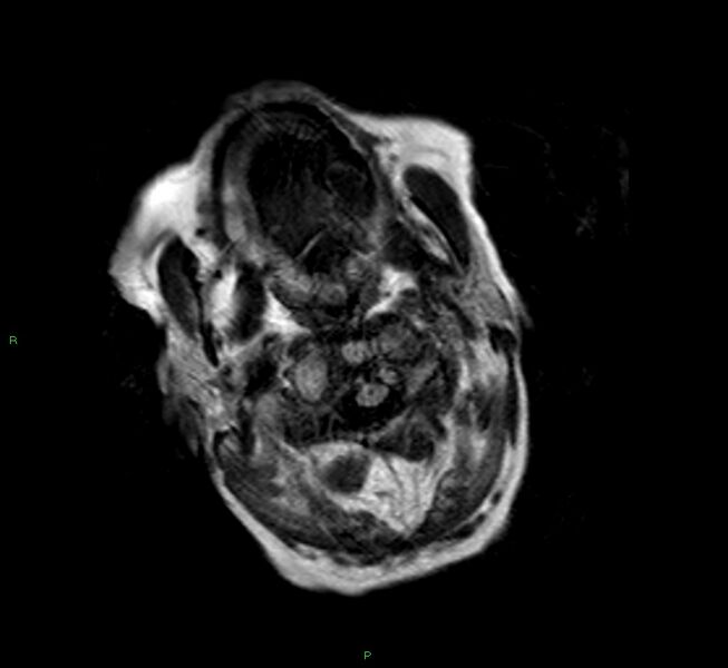 File:Cerebral amyloid angiopathy-associated lobar intracerebral hemorrhage (Radiopaedia 58377-65515 Axial FLAIR 27).jpg
