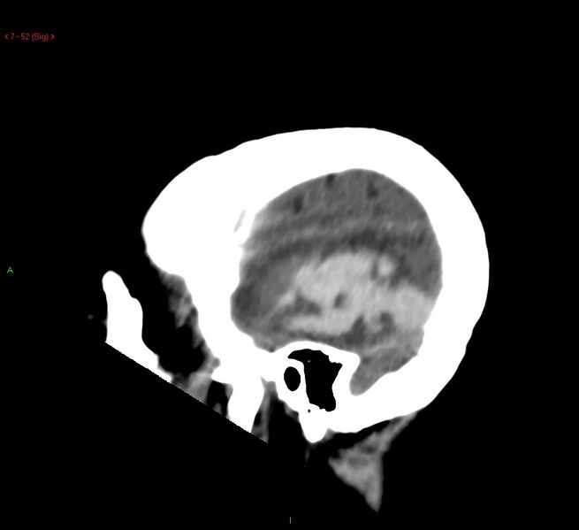 File:Cerebral amyloid angiopathy-associated lobar intracerebral hemorrhage (Radiopaedia 58378-65518 C 52).jpg