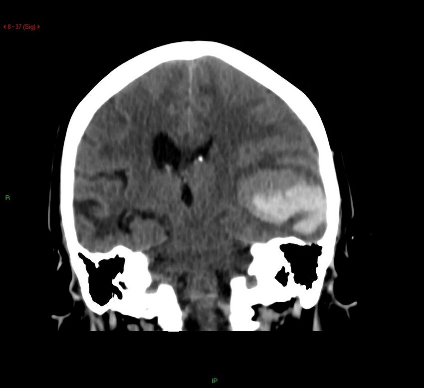 Cerebral amyloid angiopathy-associated lobar intracerebral hemorrhage (Radiopaedia 58378-65518 Coronal non-contrast 37).jpg