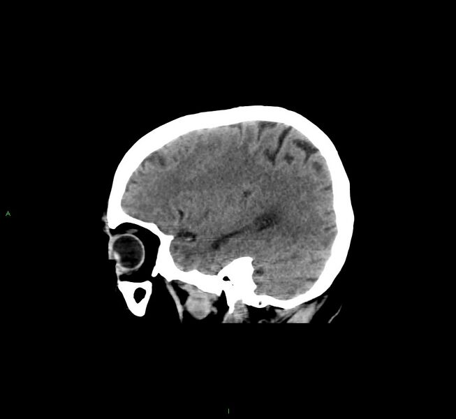 File:Cerebral amyloid angiopathy-associated lobar intracerebral hemorrhage (Radiopaedia 58529-65681 B 14).jpg