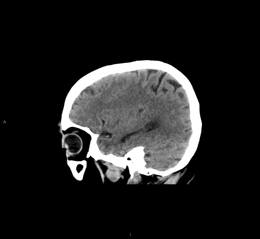 Cerebral amyloid angiopathy-associated lobar intracerebral hemorrhage (Radiopaedia 58529-65681 B 14).jpg