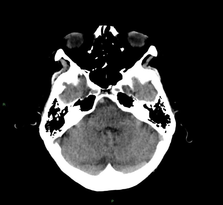 Cerebral amyloid angiopathy-associated lobar intracerebral hemorrhage (Radiopaedia 58530-65688 Axial non-contrast 38).jpg