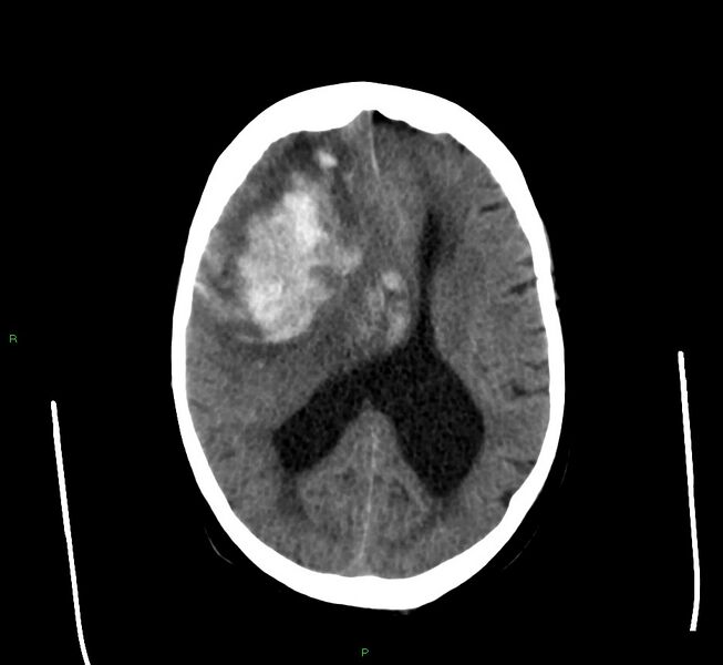 File:Cerebral amyloid angiopathy-associated lobar intracerebral hemorrhage (Radiopaedia 58560-65723 Axial non-contrast 23).jpg