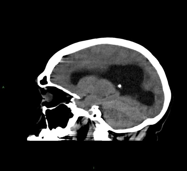 File:Cerebral amyloid angiopathy-associated lobar intracerebral hemorrhage (Radiopaedia 58560-65723 C 33).jpg
