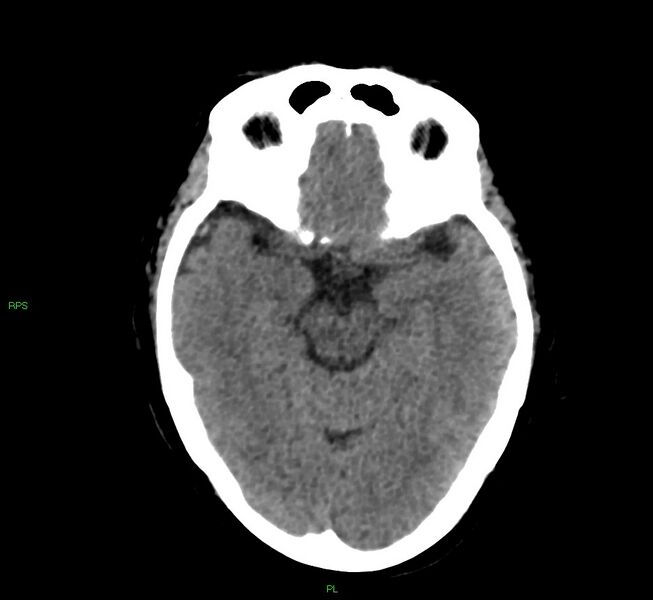 File:Cerebral amyloid angiopathy-associated lobar intracerebral hemorrhage (Radiopaedia 58569-65734 Axial non-contrast 39).jpg
