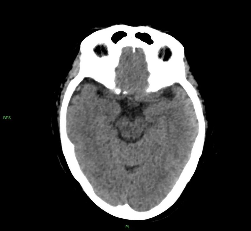 Cerebral amyloid angiopathy-associated lobar intracerebral hemorrhage (Radiopaedia 58569-65734 Axial non-contrast 39).jpg
