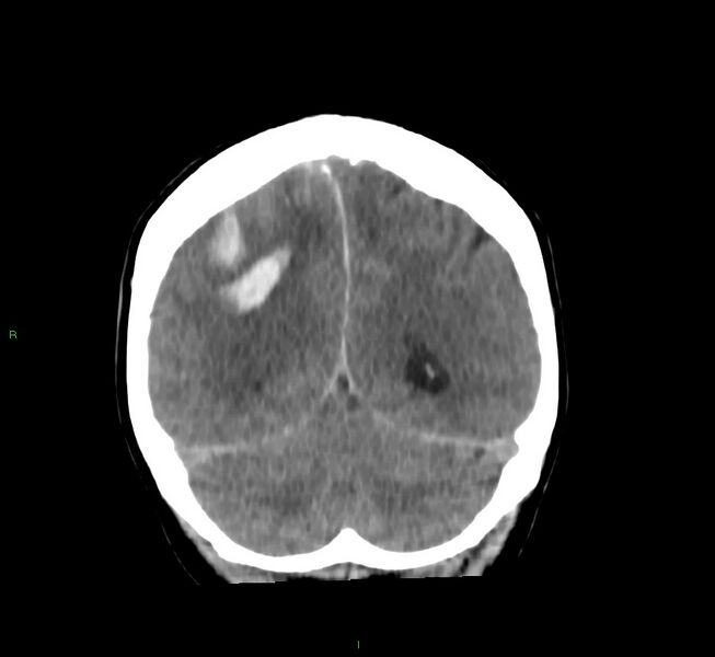 File:Cerebral amyloid angiopathy-associated lobar intracerebral hemorrhage (Radiopaedia 58756-65977 Coronal non-contrast 21).jpg