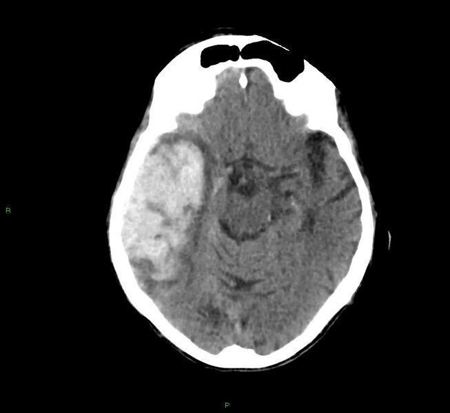 File:Cerebral amyloid angiopathy-associated lobar intracerebral hemorrhage (Radiopaedia 58758-65980 Axial non-contrast 31).jpg