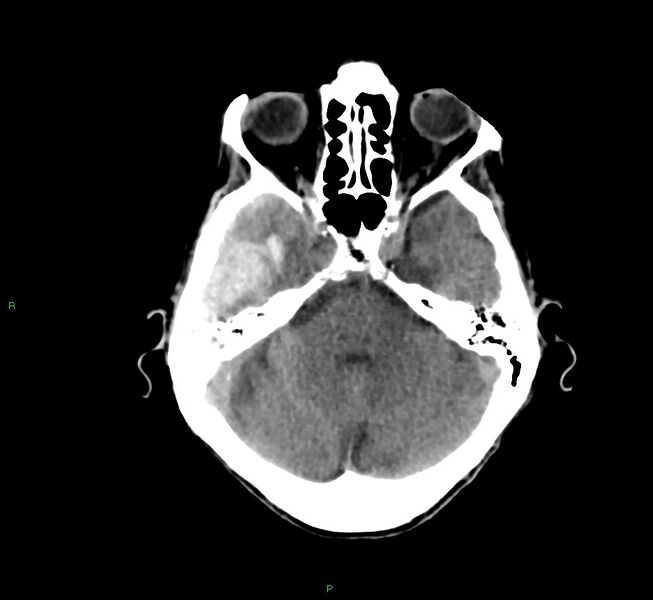 File:Cerebral amyloid angiopathy-associated lobar intracerebral hemorrhage (Radiopaedia 58758-65980 Axial non-contrast 36).jpg