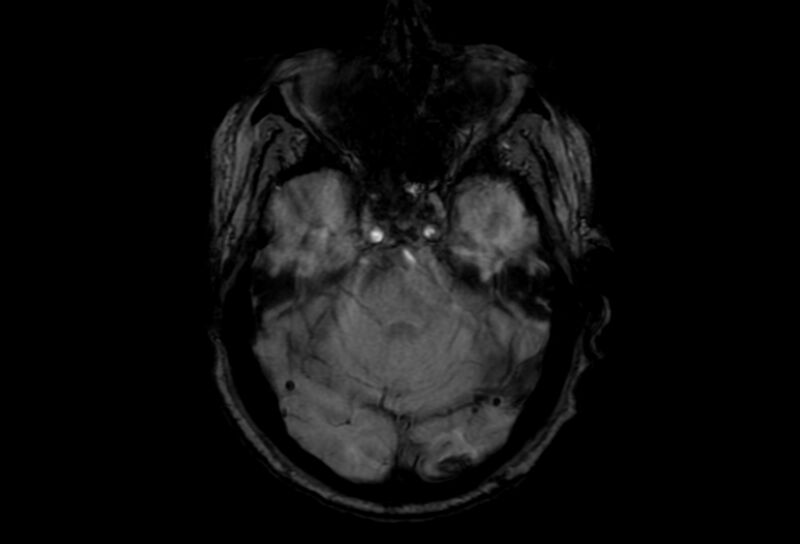 File:Cerebral amyloid angiopathy (Radiopaedia 86671-102792 Axial Gradient Echo 40).jpg