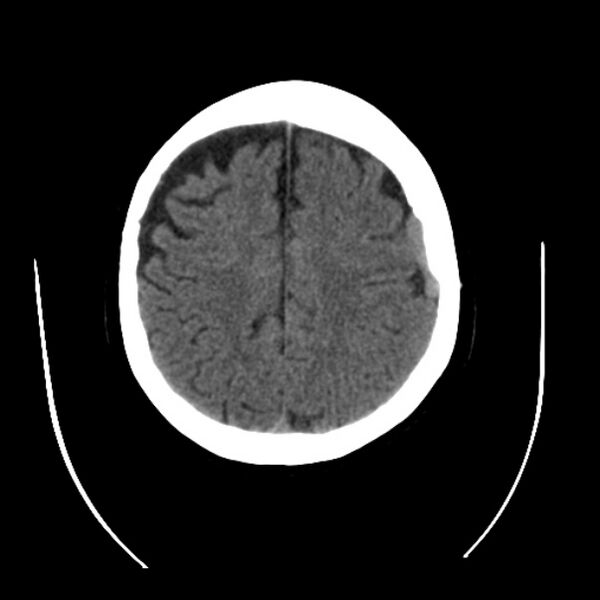 File:Cerebral arteriovenous malformation (Radiopaedia 43729-47189 Axial non-contrast 32).jpg