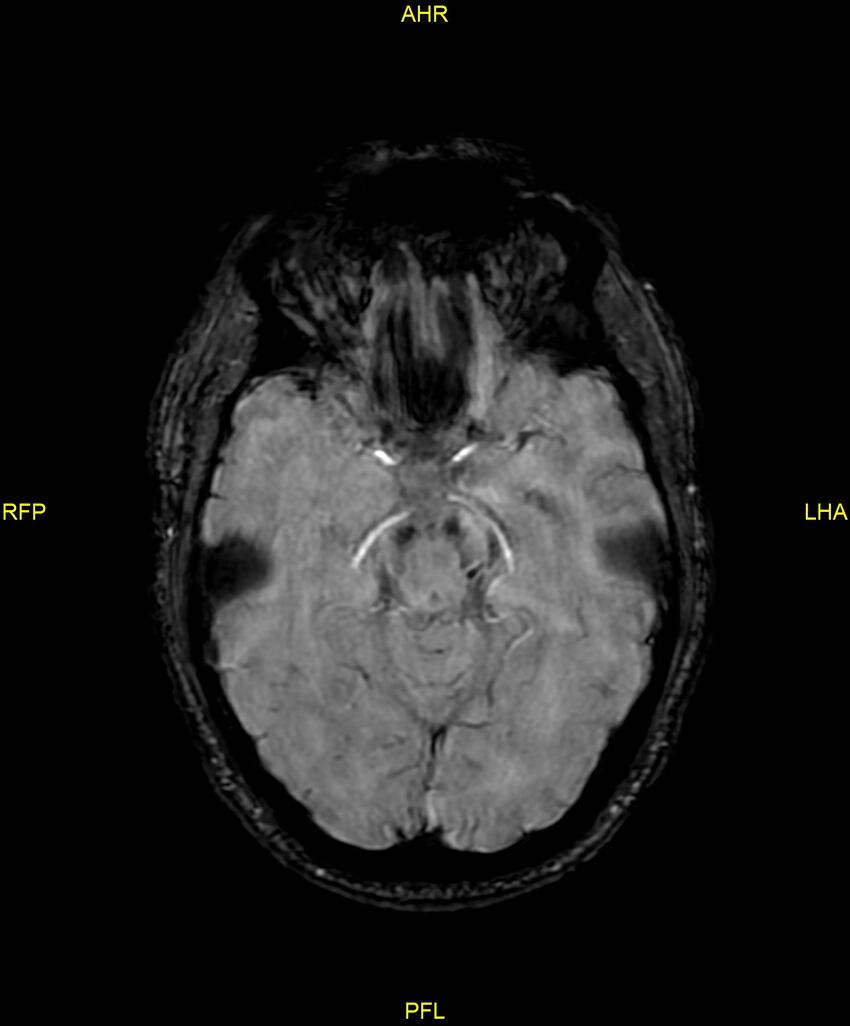 Cerebral autosomal dominant arteriopathy with subcortical infarcts and leukoencephalopathy (CADASIL) (Radiopaedia 86108-102054 Axial SWI 44).jpg