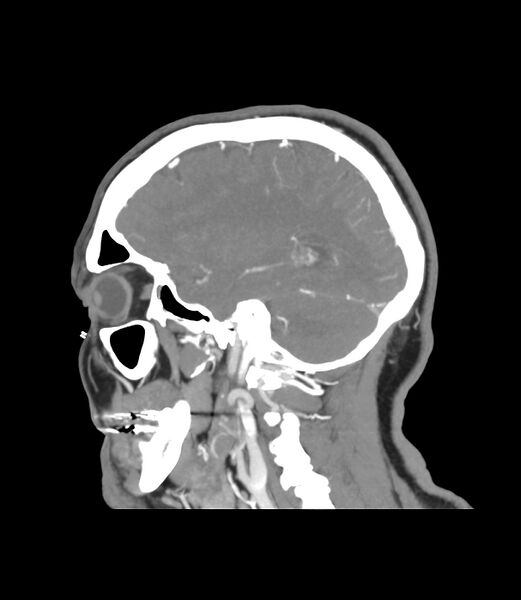 File:Cerebral dural venous sinus thrombosis (Radiopaedia 86514-102576 C 13).jpg