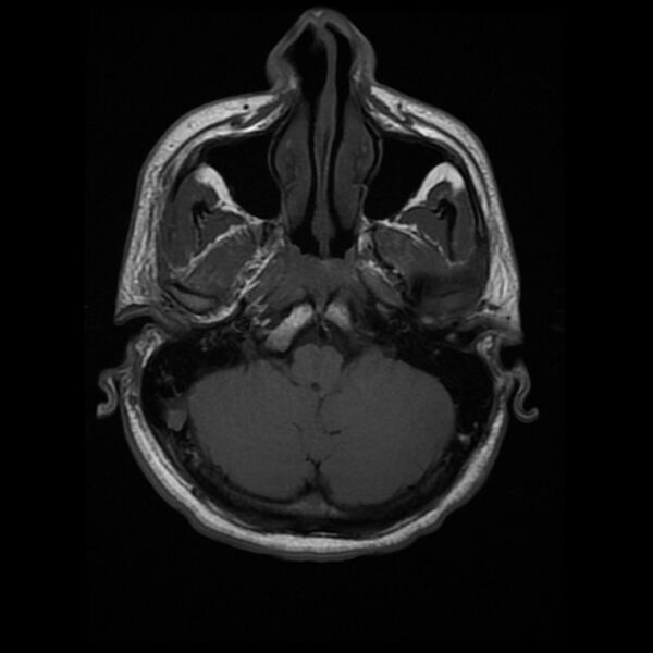 File:Cerebral fat embolism (Radiopaedia 37510-39363 Axial T1 6).jpg