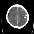 Cerebral hemorrhagic contusions (Radiopaedia 23145-23188 Axial non-contrast 30).jpg