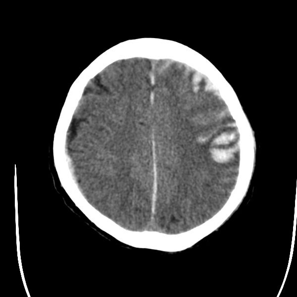 File:Cerebral hemorrhagic contusions (Radiopaedia 23145-23188 Axial non-contrast 30).jpg