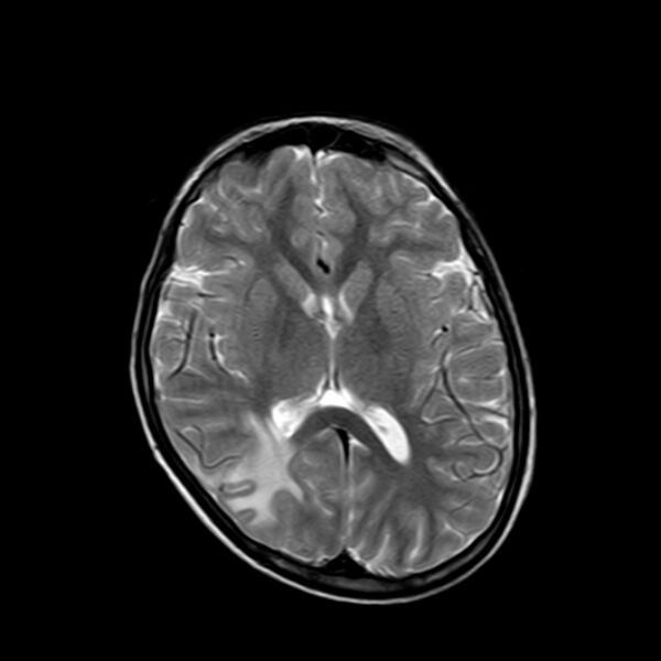 File:Cerebral tuberculoma (Radiopaedia 41152-43932 Axial T2 12).jpg