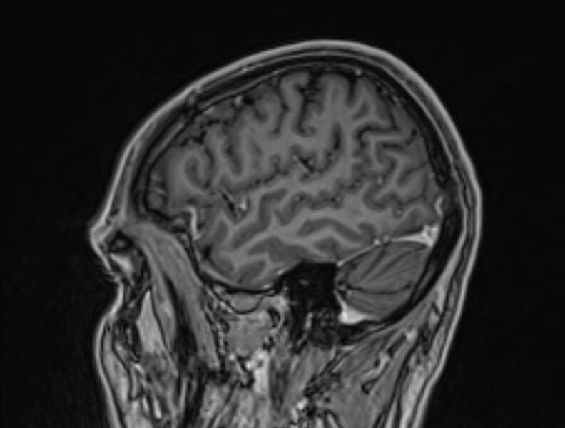 File:Cerebral venous thrombosis (Radiopaedia 71207-81504 Sagittal T1 C+ 9).jpg
