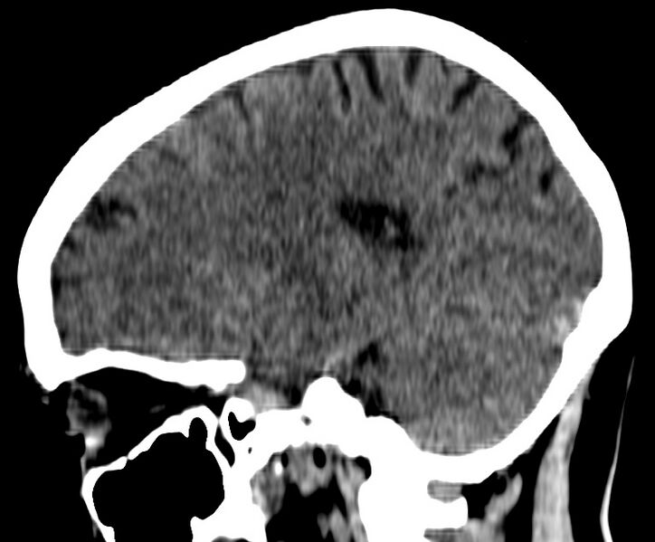 File:Cerebral venous thrombosis - CT only (Radiopaedia 41031-43778 B 25).jpg