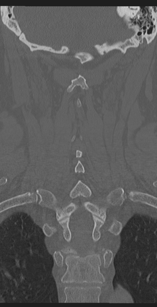File:Cervical canal stenosis - OPLL and osteophytes (Radiopaedia 47329-51910 Coronal bone window 44).png