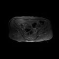 Cervical carcinoma (Radiopaedia 78847-91705 Axial T2 fat sat 5).jpg