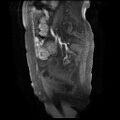 Cervical carcinoma (Radiopaedia 78847-91705 I 13).jpg