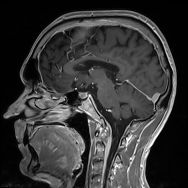 File:Cervical dural CSF leak on MRI and CT treated by blood patch (Radiopaedia 49748-54995 G 52).jpg
