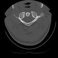 Cervical flexion teardrop fracture with cord hemorrhage (Radiopaedia 32497-33454 Axial bone window 18).jpg