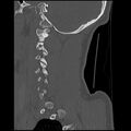 Cervical flexion teardrop fracture with cord hemorrhage (Radiopaedia 32497-33454 Sagittal bone window 9).jpg