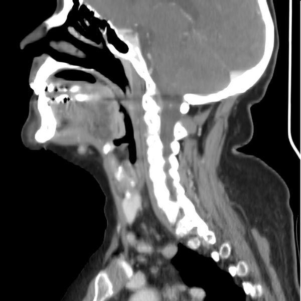 File:Cervical lymphadenopathy- cause unknown (Radiopaedia 22420-22457 D 17).jpg