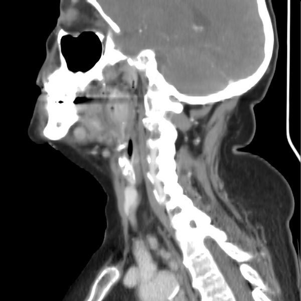 File:Cervical lymphadenopathy- cause unknown (Radiopaedia 22420-22457 D 24).jpg