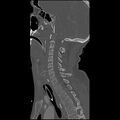 Cervical spine fractures with vertebral artery dissection (Radiopaedia 32135-33078 Sagittal bone window 18).jpg
