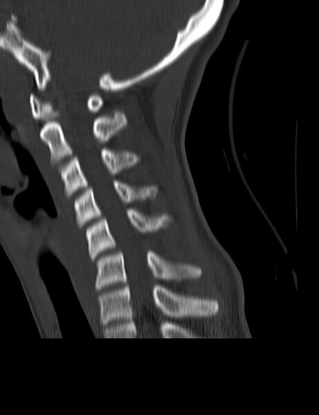 File:Cervical spine posterior ligamentous complex rupture (Radiopaedia 63486-72101 Sagittal bone window 10).jpg