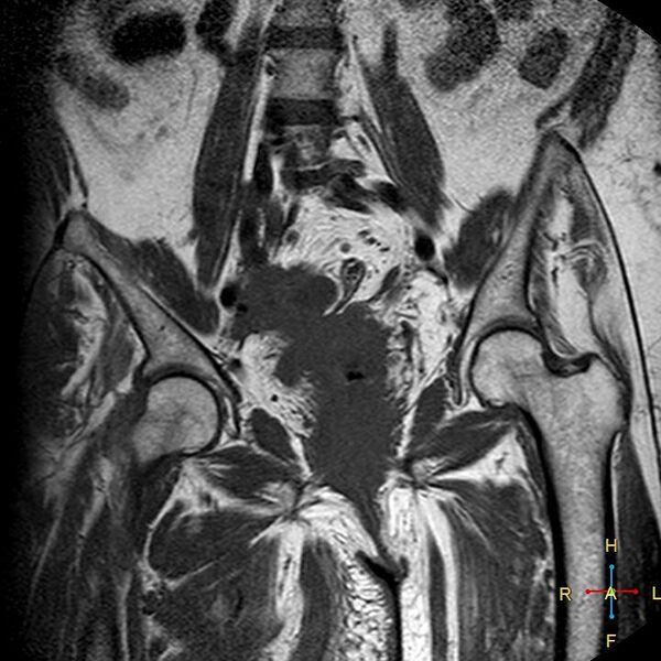 File:Cervical stump squamous cell carcinoma (Radiopaedia 48049-52858 Coronal T1 8).jpg